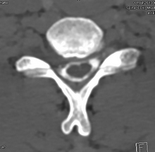 Myelographie-CT: Der Duralsack ist mit Kontrastmittel (weiss) gefüllt. Verdrängung des Rückenmarkes durch einen Bandscheibenvorfall bei C6/C7 rechts.