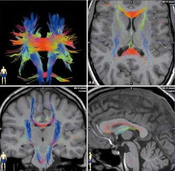 Darstellung von Fasersystemen im Gehirn im MR