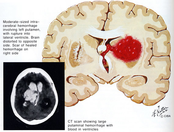 Nicht unfallbedingte Blutungen des Gehirnes, (aus F.H.Netter, The Ciba Collection, Colorpress, New York)