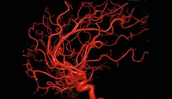 3D-Angiogramm der A.carotis interna seitlich
