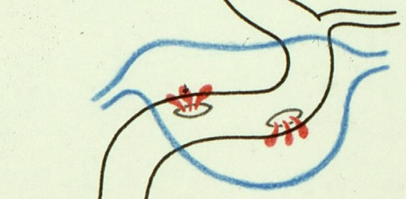 Die Skizze zeigt Verletzungen der Arteria carotis interna (schwarz) im Sinus cavernosus (blau) nach Schädelbasisfraktur.