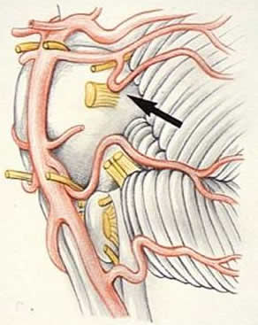 Die Skizze zeigt die Berührung zwischen Arterie und Trigeminusnerv