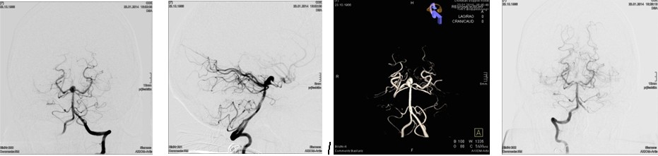 Bilder: Aneurysma der Arteria communicans anterior vor und nach Coiling
