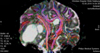 Bild: Kernspintomographie - Traktographie (engl. Fibertracking): Der Verlauf größerer Nervenfaserbündel im Gehirn wird vor Tumor-Operationen rekonstruiert und dargestellt, um Schäden an wichtigen Nervenfasersträngen zu verhindern. Bild: SALK