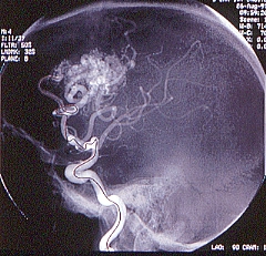 Angiogramm einer zerebralen AVM. Der dargestellte Mikrokatheter reicht mit Spitze bis zum AVM-Nidus.