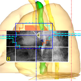 Bildgeführte Radiotherapie (IGRT) Der Schritt in die vierte Dimension