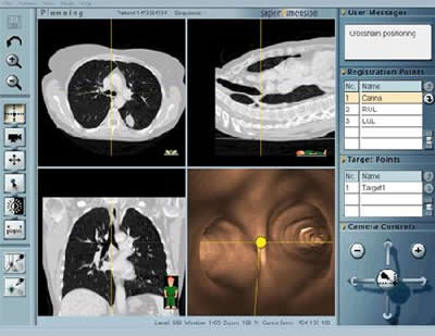 Virtuelle Bronchoskopie in der Planungs-und Vorbereitungsphase der Navigationsbronchoskopie