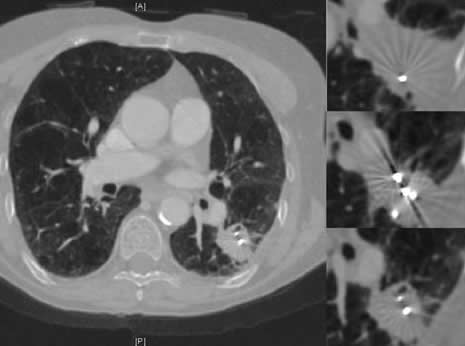 Goldmarker in einem Tumor im linken Lungenunterlappen