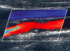 Doppler-Sonographie einer thrombotisch und sklerotisch eingeengten Halsarterie (A. carotis)