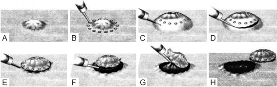 Abb. 1 Endoskopische Submukosa-Disektion (nach N. Yahagi et al., Dig. Endosc, 2004)