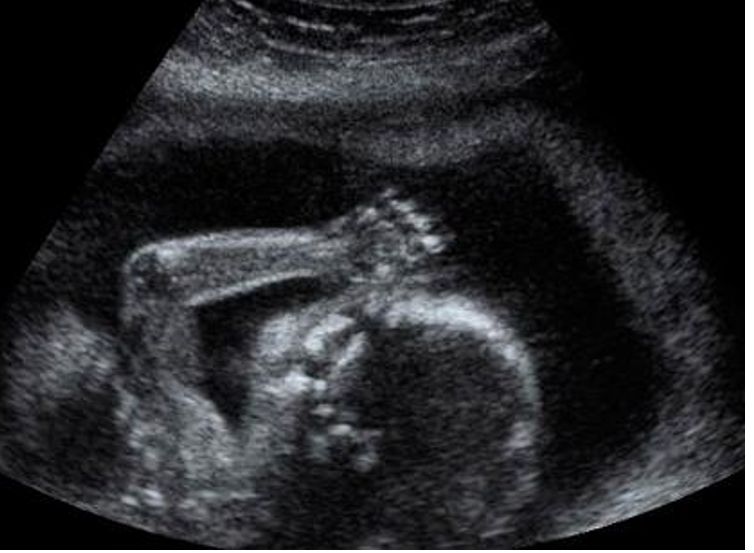 Ultraschallbild in der Schwangerschaft